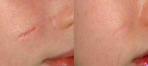 Scar-Removal-Before-and-After-Images-2-1.jpg-nggid03110-ngg0dyn-1280x922x100-00f0w010c010r110f110r010t010-1