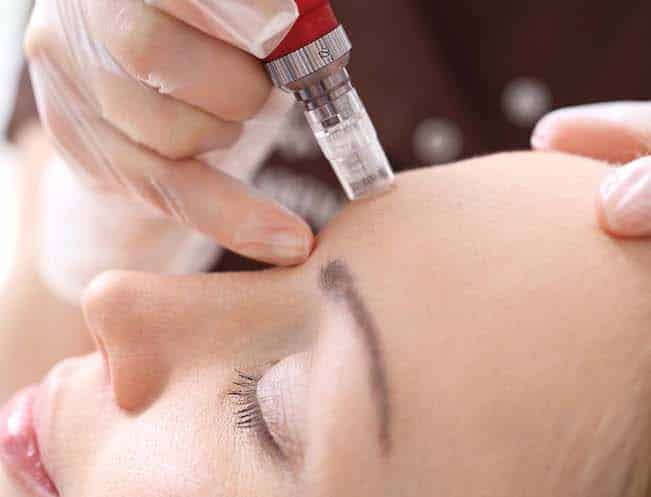 Microneedling - Face 2 copy